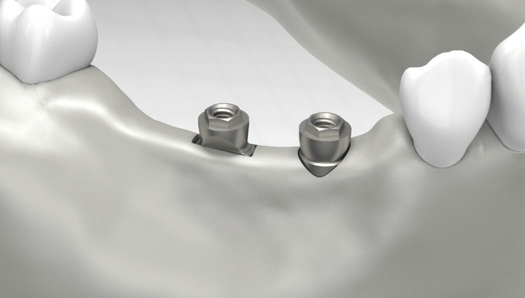Problematik bei Verwendung von runden Standard-Implantaten in schmalen Kieferknochen