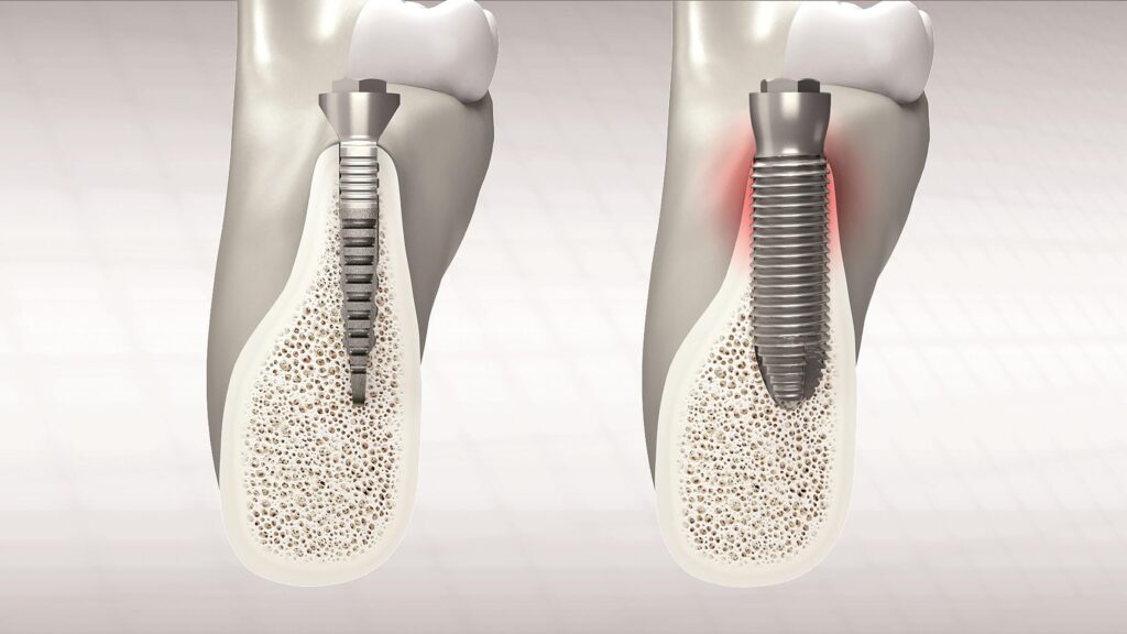 Vorteil REX-Implantat bei schmalem Kieferknochen