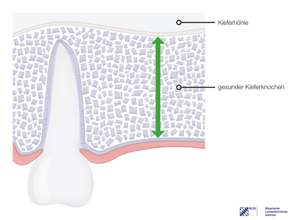 Gesunder Kieferknochen – Einsetzen eines Standardimplantats möglich