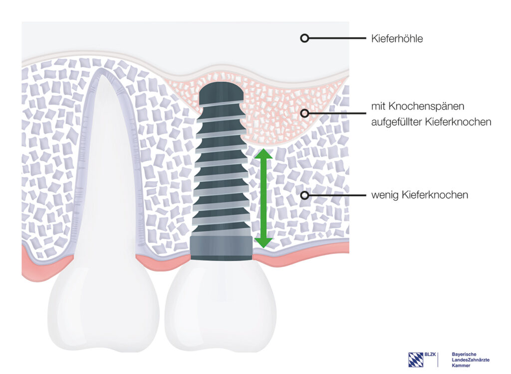 Einsatz von DIVA-Implantat – das Knochenersatzmaterial wird durch das Implantat in die richtige Postion eingebracht